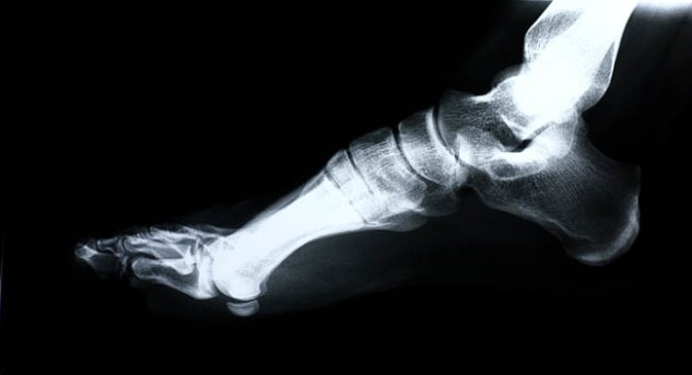 Open Reduction and Internal Fixation of a Foot Fracture by OrangeCountySurgeons.org  (2)